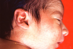 rubinstein-taybi-2004-003