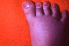 rubinstein-taybi-8m-011