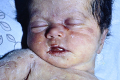 sifilis-lues-congenita-choque-septico-1997-002