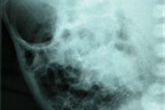 signo-de-la-carrilera-enterocolitis-002