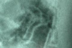 signo-de-la-carrilera-neumatosis-intestinal-000
