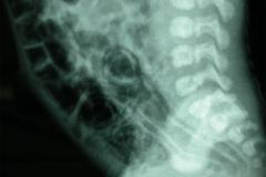 signo-de-la-carrilera-neumatosis-intestinal-002