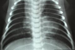 silueta-cardiaca-en-zueco-000