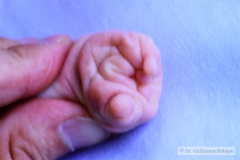 simbraquidactilia-mano-der-000