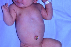 simbraquidactilia-mano-der-003