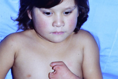 simbraquidactilia-mano-izq-1988-000
