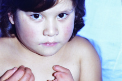 simbraquidactilia-mano-izq-1988-005