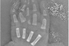 sindactilia-dedos-3-4-5-mano-der-1984-000