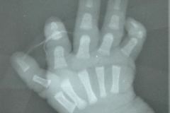 sindactilia-dedos-4-5-reduccion-longitudinal-axial-2-dedo-mano-izq-1989-000