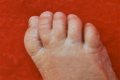 sindactilia-mano-bil-dedo-3-4-pie-bil-dedo-2-3-1987-005