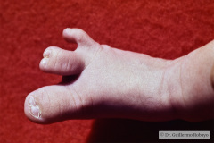 sindactilia-pie-der-dedo-1-2-y-3-4-1989-000