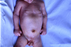 sindrome-purpurico-escoriacion-piel-esparadrapo-000