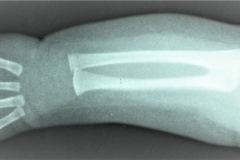 sinostosis-radio-cubital-izq-1989-000