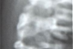 sinostosis-vertebral-000