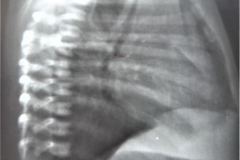 sinostosis-vertebral-001