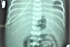 situs-indeterminado-arco-ao-der-ventriculo-unico-canal-av-atresia-p-dap-ascitis-2004-004