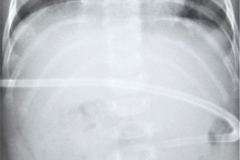 sonda-de-gastrostomia-1985-000