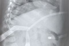 sonda-de-gastrostomia-1985-001