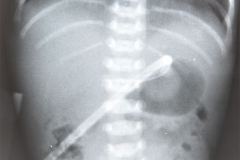 sonda-de-gastrostomia-000