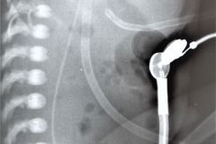 sonda-de-gastrostomia-001