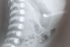 sonda-de-gastrostomia-003