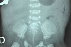 sonda-vesical-cateter-femoral-bil-arterial-y-venoso-000