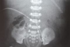 sonda-vesical-sobreinsertada-y-correccion-000