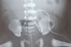sonda-vesical-sobreinsertada-y-correccion-001