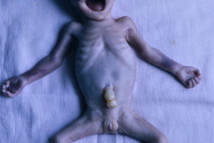 steinert-distrofia-miotonica-tipo-i-luxacion-temporomandibular-1990-000
