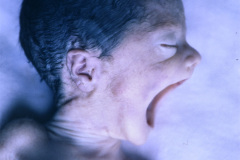 steinert-distrofia-miotonica-tipo-i-luxacion-temporomandibular-1990-002