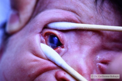 stickler-con-secuencia-pierre-robin-vitreoretinopatia-cataratas-coloboma-iris-sindactilia-mano-izq-002
