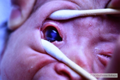stickler-con-secuencia-pierre-robin-vitreoretinopatia-cataratas-coloboma-iris-sindactilia-mano-izq-003