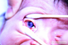 stickler-con-secuencia-pierre-robin-vitreoretinopatia-cataratas-coloboma-iris-sindactilia-mano-izq-007