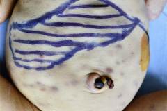 storch-sindrome-pupurico-petequias-esplenomehalia-hepatomegalia-002