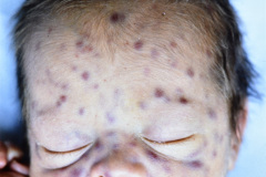 storch-sindrome-pupurico-petequias-esplenomehalia-hepatomegalia-007
