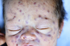 storch-sindrome-pupurico-petequias-esplenomehalia-hepatomegalia-008