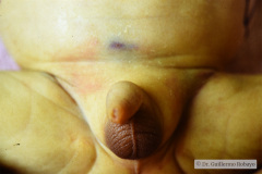 storch-sindrome-purpurico-petequias-equimosis-hematomas-hepatoesplenomegalia-001