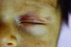 storch-sindrome-purpurico-petequias-equimosis-hematomas-hepatoesplenomegalia-003