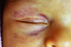 storch-sindrome-purpurico-petequias-equimosis-hematomas-hepatoesplenomegalia-004