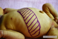 storch-sindrome-purpurico-petequias-equimosis-hematomas-hepatoesplenomegalia-012