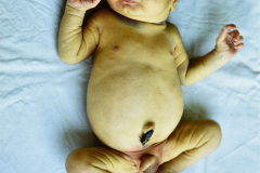 storch-sindrome-purpurico-petequias-equimosis-hematomas-hepatoesplenomegalia-017