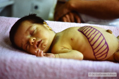 storch-sindrome-purpurico-petequias-equimosis-hematomas-hepatoesplenomegalia-019