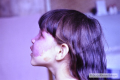 sturge-weber-4a-1981-002