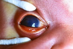 sturge-weber-hemangioma-facial-glaucoma-1987-001