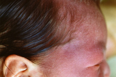 sturge-weber-hemangioma-facial-glaucoma-1987-002