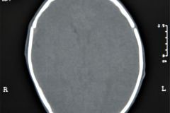 tac-cerebral-normal-1998-12-22-h.-nidia-perez-005