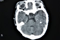 tac-cerebral-normal-1998-12-22-h.-nidia-perez-006