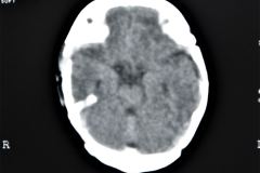 tac-cerebral-normal-1998-12-22-h.-nidia-perez-011