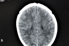 tac-cerebral-normal-1998-12-22-h.-nidia-perez-016