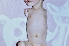 talidomida-sindrome-1988-002